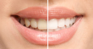 An example of before and after dental teeth whitening.